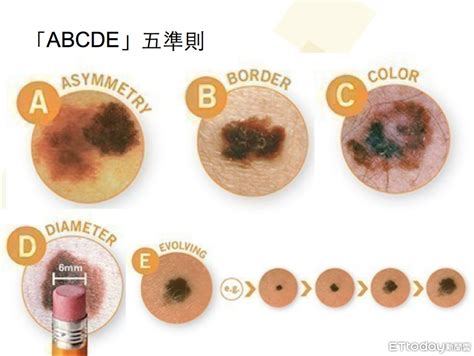 臉上多了痣|皮膚長「紅痣」會怎樣？跟黑痣有何不同？會是皮膚癌。